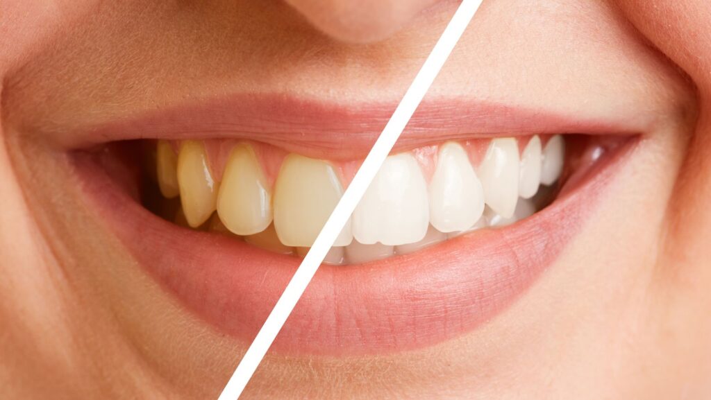 dental cosmetic treatment in kusadasi