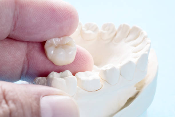 dental crown advantages