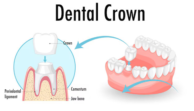 dental crowns