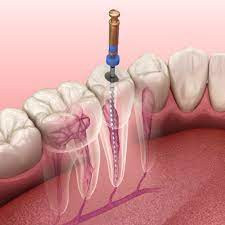 root canal tratments