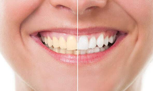 kusadasi teeth whitening