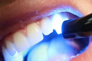 dental filling