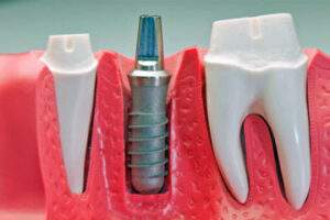 dental implants in kusadasi