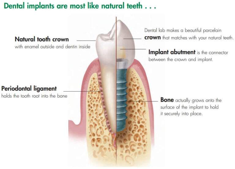 dental implant in kusadasi