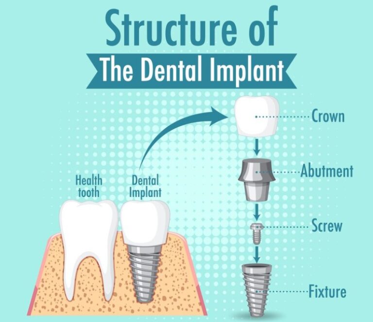 implant structure in kusadasi dental