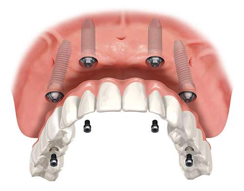 dental implant