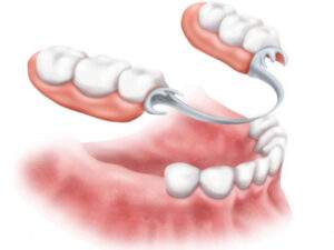 denture in turkish dentist