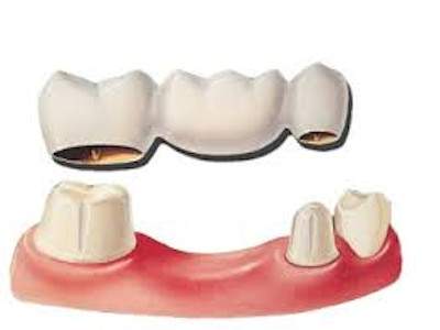 dental bridge in kusadasi