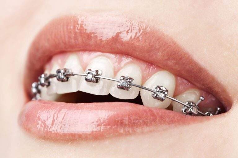 orthodontie in turkey