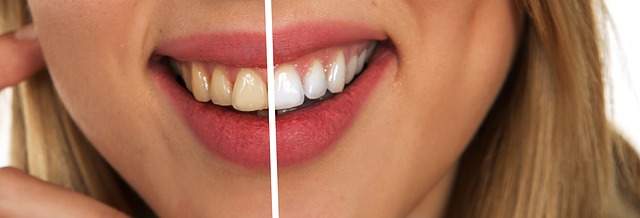 kusadasi teeth whitening