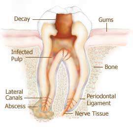 root canal treatment