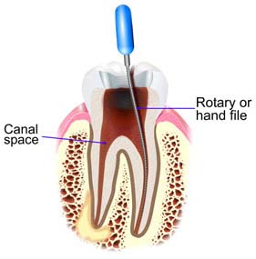 dental root  canal