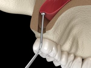 sinus augmentation