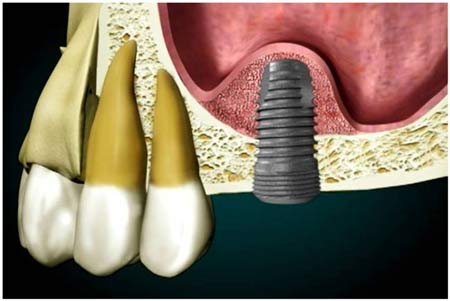 sinus lifting surgery